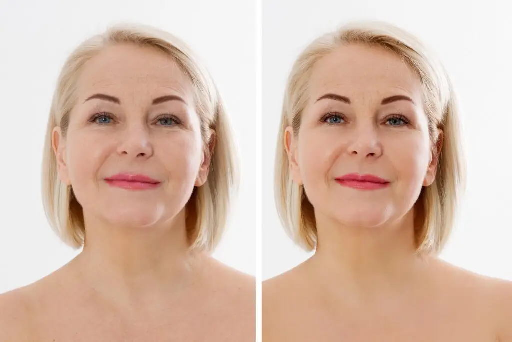 Botox results for upper face wrinkles on female patient – Marietta