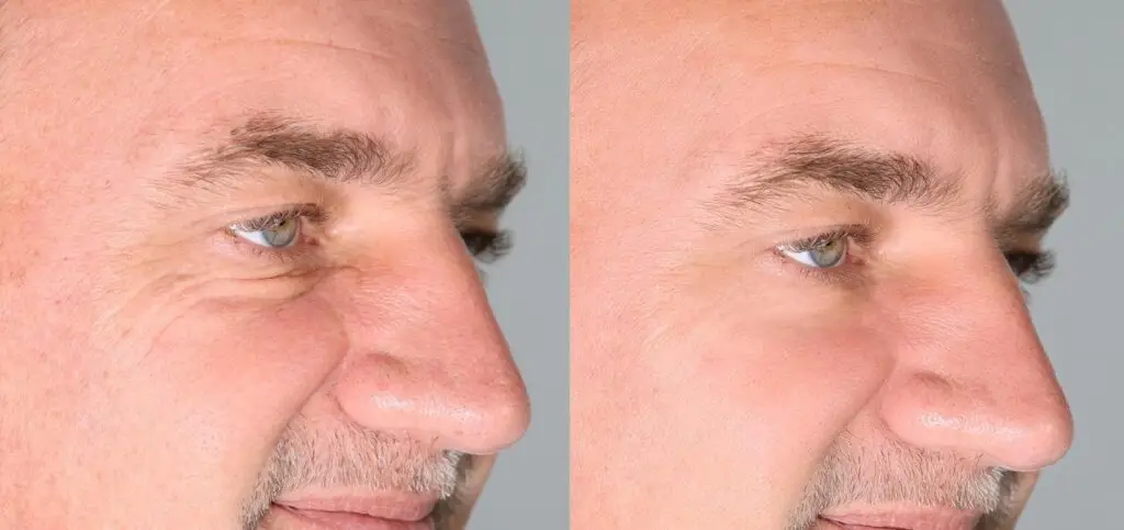 Before and after full face Botox on male patient – Norcross