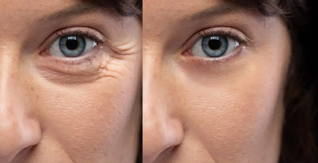botox-eye-area-closeup-before-after-the-maxim-clinic-atlanta-ga