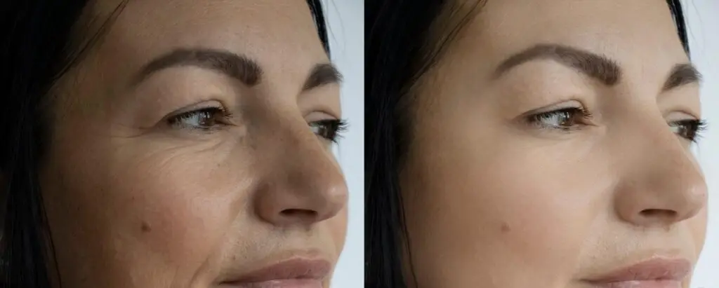 botox-female-profile-results-marietta-ga