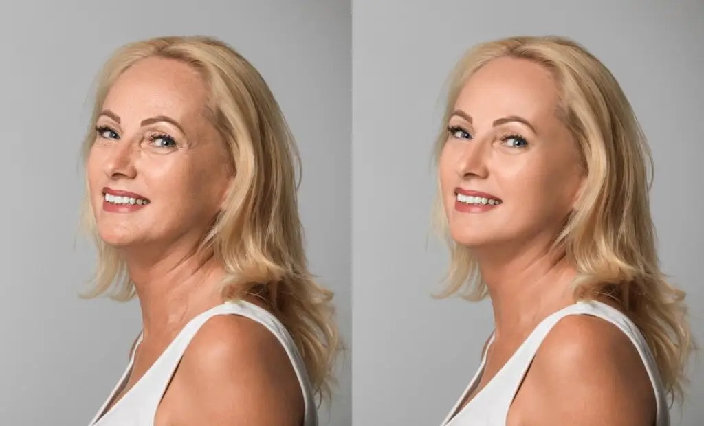 botox-full-face-female-before-after-atlanta-ga