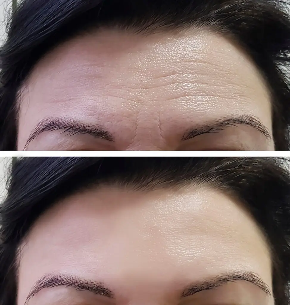 forehead women wrinkles before and after botox in atlanta, ga at the maxim clinic