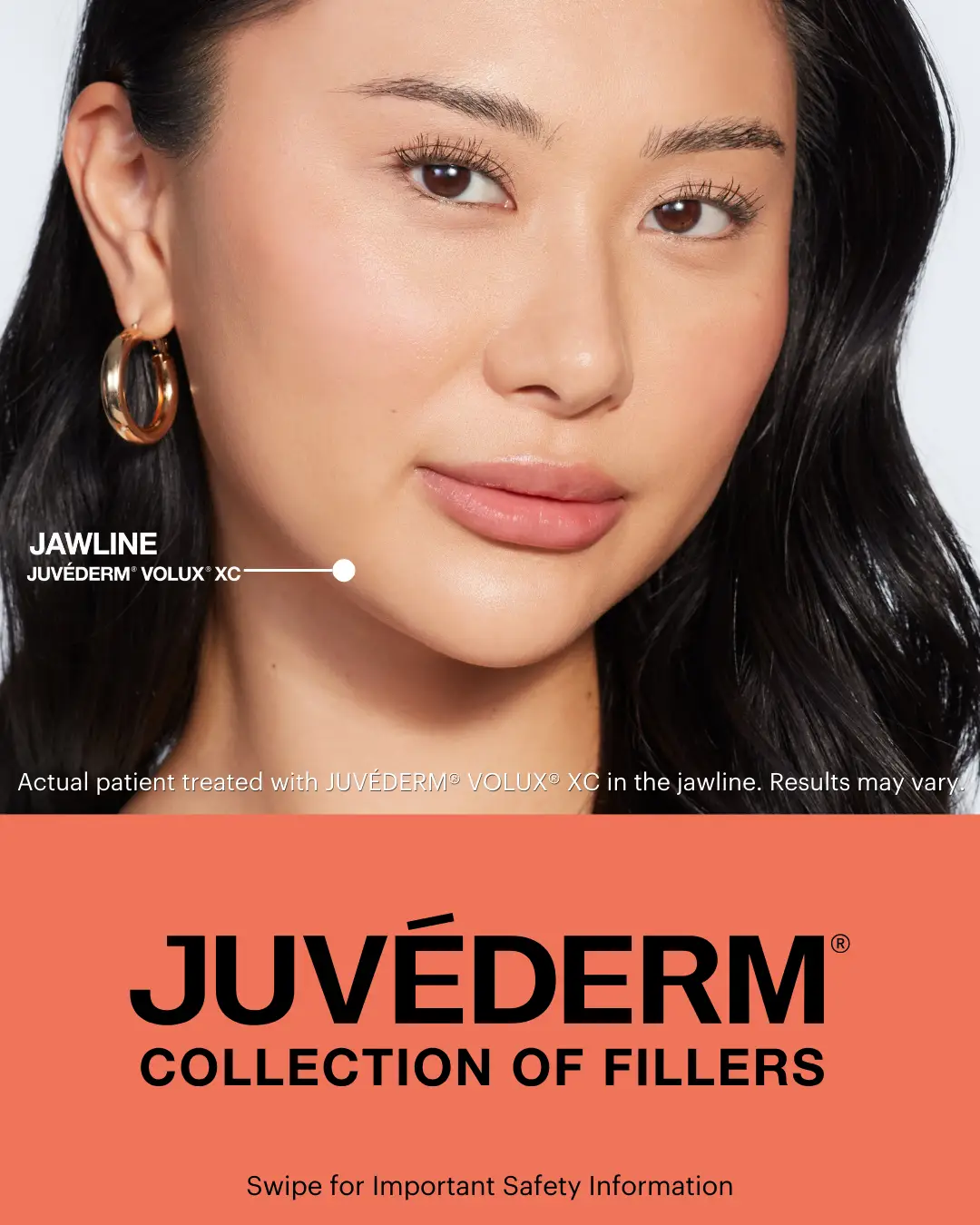 Sara model after Volux filler, showing natural chin contour.