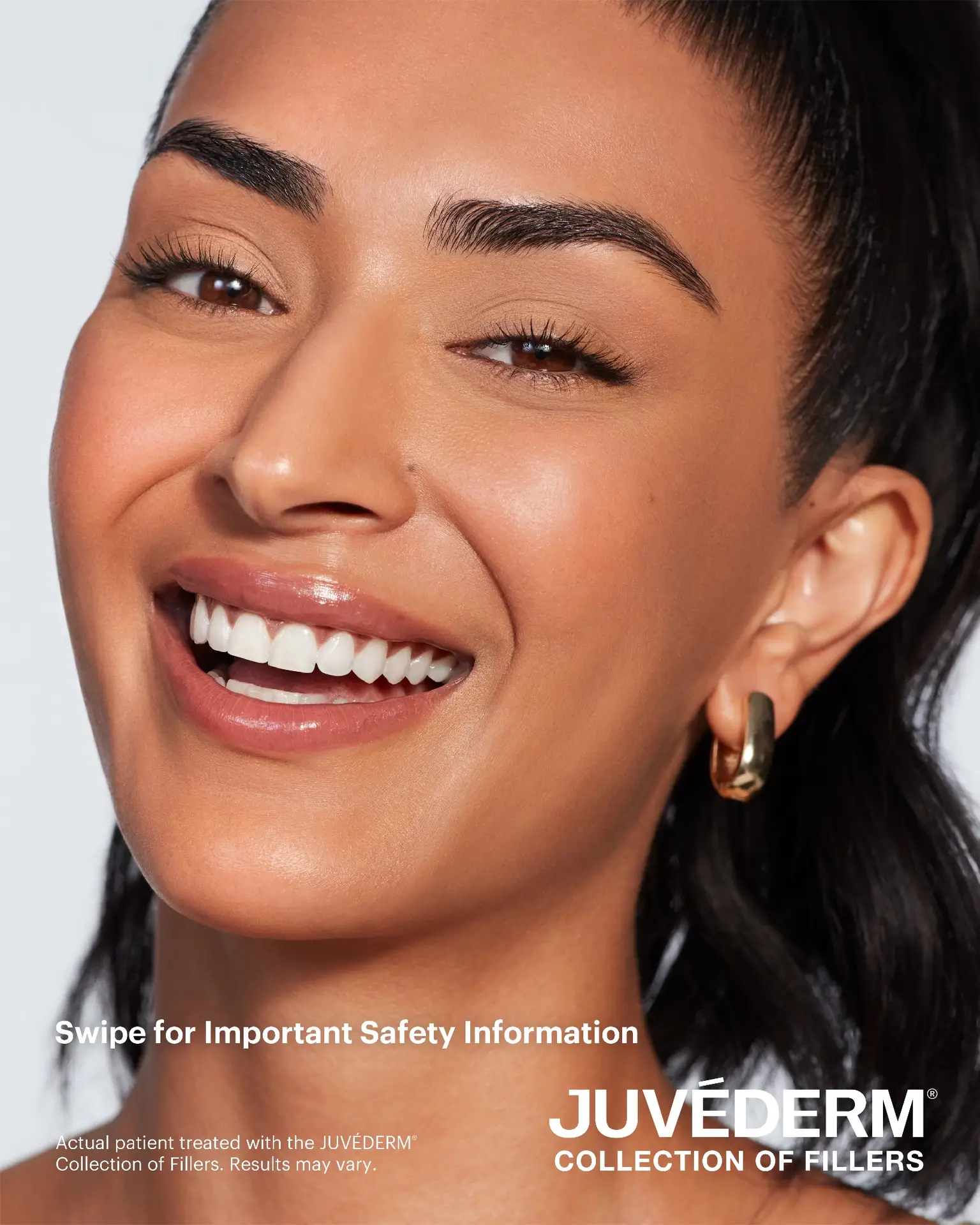 Natural lip definition — perioral balance