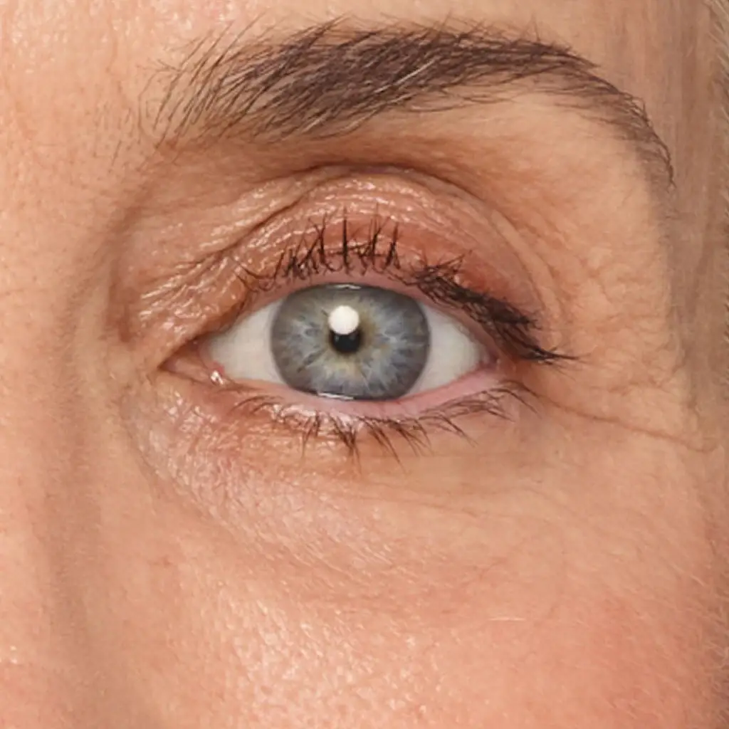Juvéderm for Undereyes Patient results after undereye filler for tear troughs.
