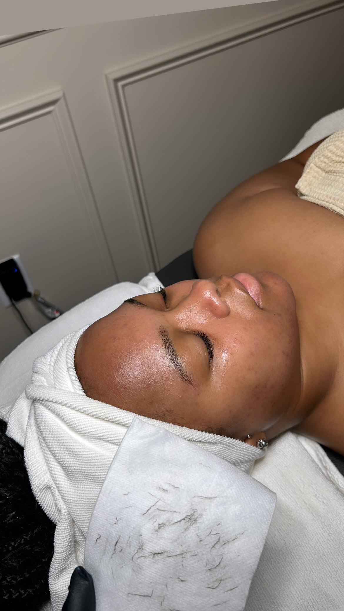 A precise and sterile dermaplaning treatment being performed at The Maxim Clinic