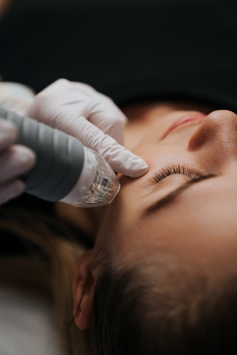Microneedling at The Maxim Clinic — smoother texture and refined pores