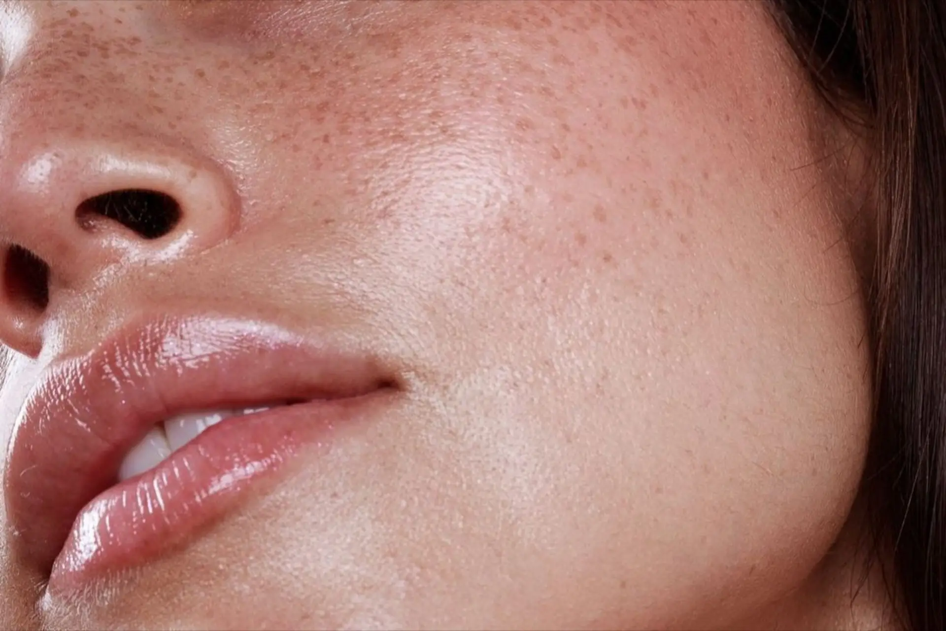 A precision clinical close-up of natural-looking Botox and lip filler results for a patient at The Maxim Clinic, providing physician-led aesthetics in Marietta, Norcross, and Peachtree Corners.
