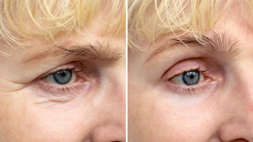 Three Fast JUVÉDERM Treatments For Ozempic Sagging Face from Weight Loss in Norcross, Marietta, and North Atlanta, Georgia